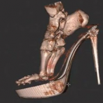 3D Scan Shows Foot Damage From High Heels